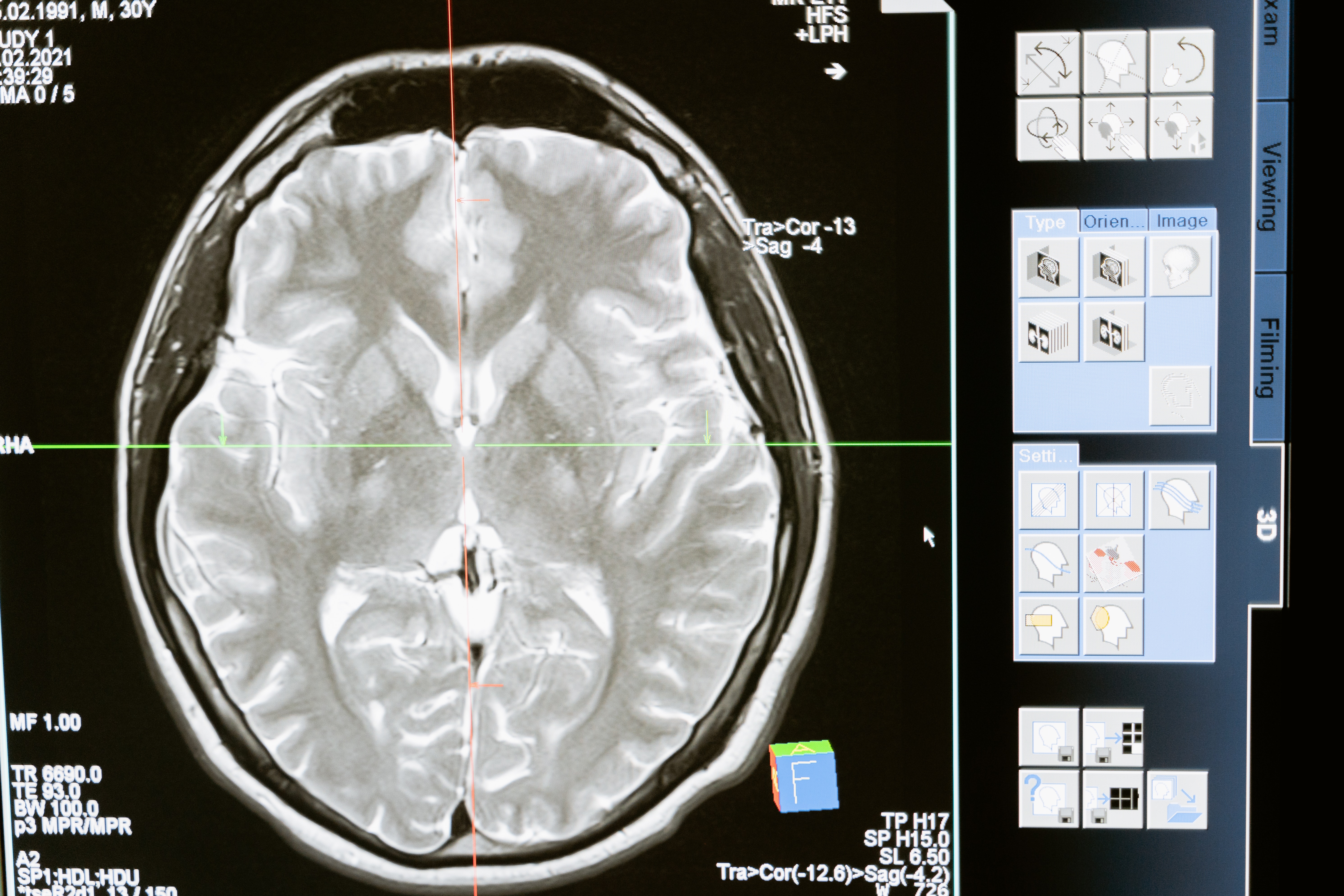 MS treatment landscaping and decision-making